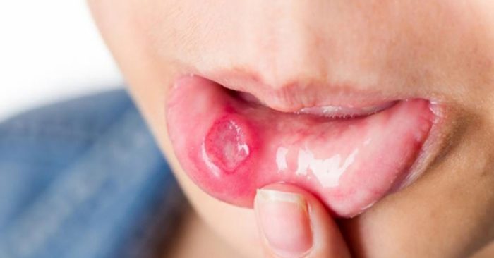 Khô môi, nhiệt miệng, thường xuyên chảy máu: Dấu hiệu sớm của bệnh ung thư miệng